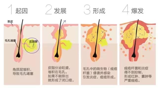 不同时期的战甲,夏日战痘全攻略