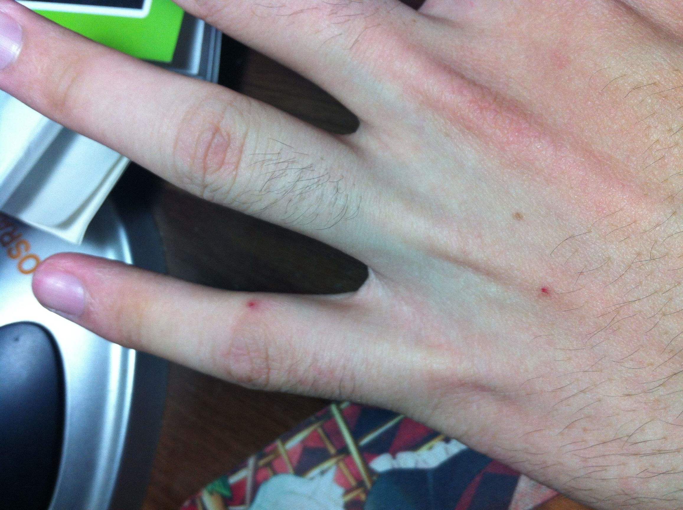 身上长小红点不痛不痒变成黑点,身上长红点像红色小痣怎么回事