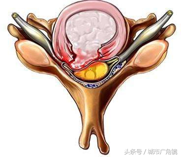 腰椎间盘突出脚底板麻木如何治疗,腰椎间盘突出腿麻木最快缓解针灸