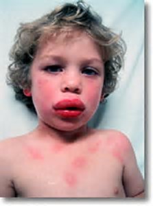 上火流鼻血能降火吗,喝金银花流鼻血是怎么回事