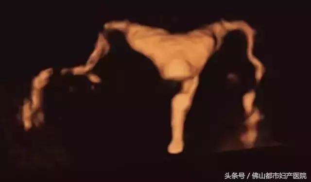 四维超声输卵管造影亲身经历,无痛四维输卵管造影