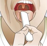 牛皮癣与hpv有关系吗,牛皮癣与血沉有关吗