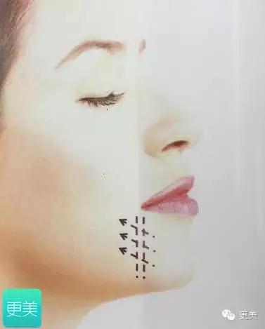 脸部缝美容线好还是普通线好,医院埋线和美容院埋线有什么差别