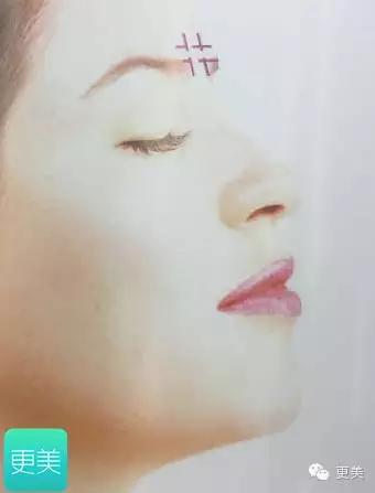 埋线美容线和不吸收线有什么区别,医院埋线和美容院埋线有什么差别