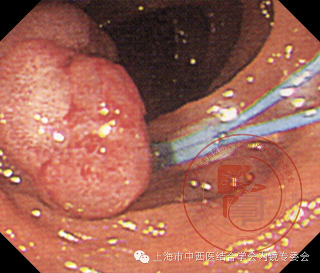内镜套扎是什么,内镜套扎器械