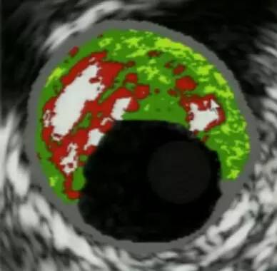 冠脉病变钙化旋磨术的并发症,冠脉钙化病变旋磨术