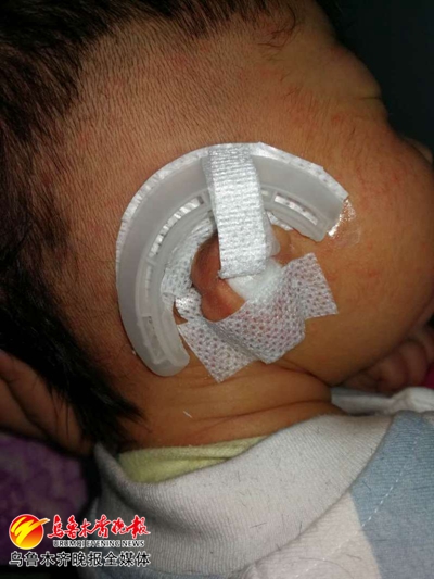 小乐乐不再“与众不同”*疆新**首例先天耳畸形无创矫正术成功