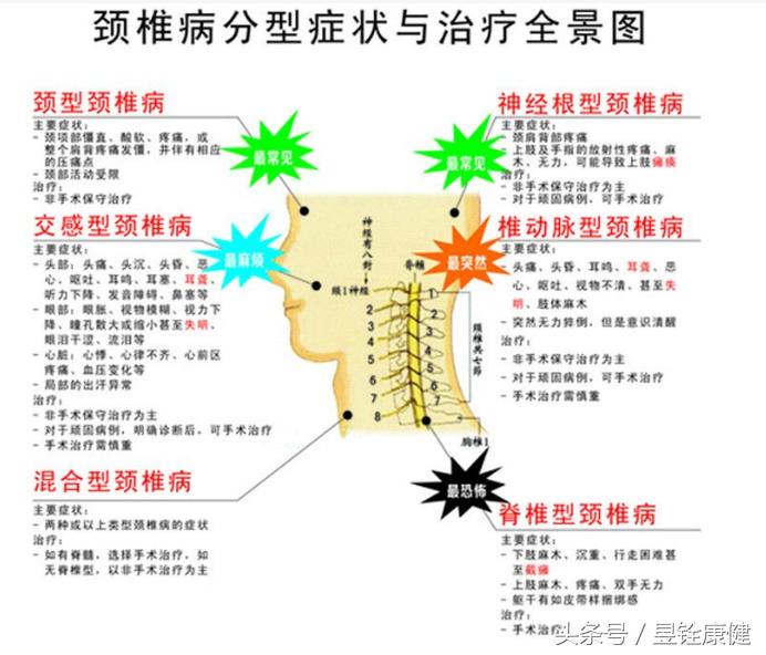 颈椎病这些知识您了解吗,颈椎病常见康复治疗方法
