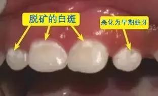 牙齿脱钙还能恢复吗,说出来可能你不信图片