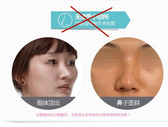 长沙隆鼻哪个医生好,长沙隆鼻专家揭秘