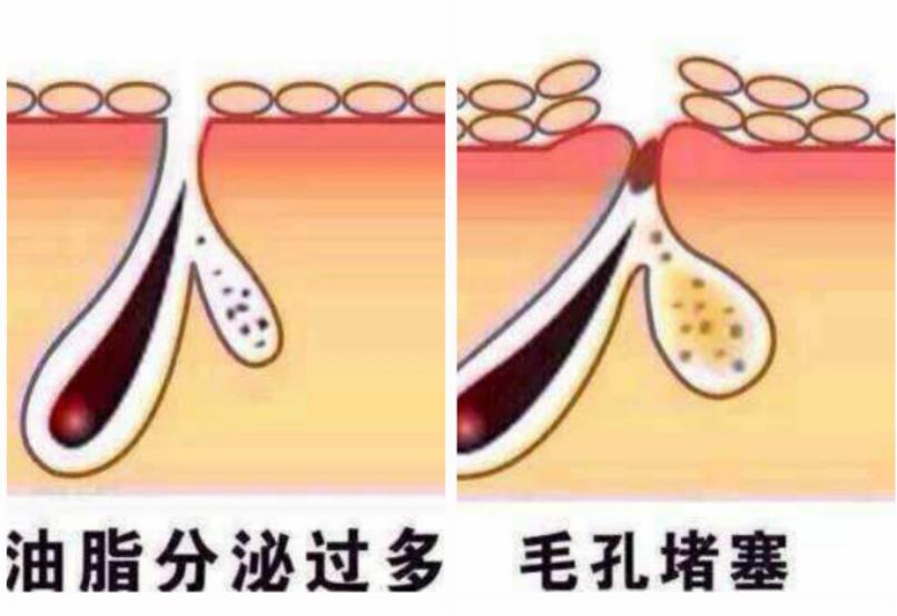 毛孔粗大怎么改善有效果,毛孔粗大真实有效改善