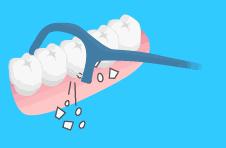 塞牙塞的厉害怎么办,塞牙塞到牙龈里咋回事