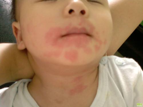 3岁宝宝反复发作过敏性*麻疹荨**,元凶竟然是它