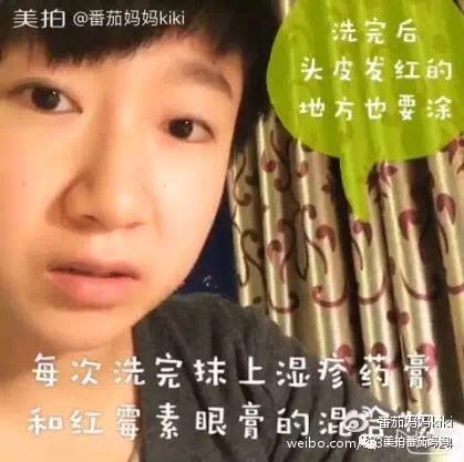 幼儿头垢和湿疹结痂的区别,湿疹洗澡用什么清洗