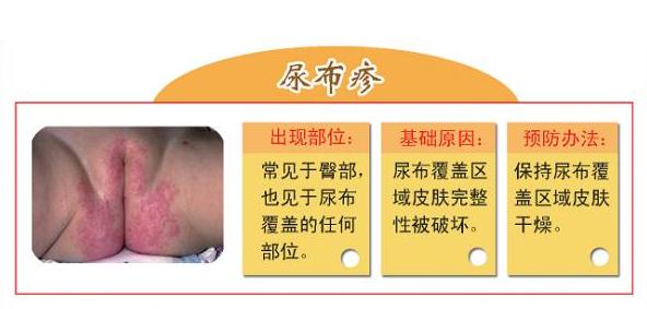 为什么尿布疹搽了药还是那么红,为什么出现尿布疹