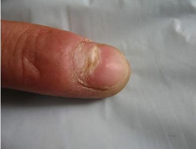 治疗灰指甲被骗一万多,治疗灰指甲的亲身经历