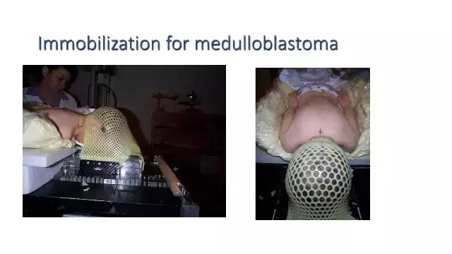 演讲PPT/法国居里研究所皮埃尔贝：儿童神经肿瘤的质子放疗