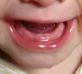 怎样缓解长牙期不适,孩子长牙怎么缓解不适感