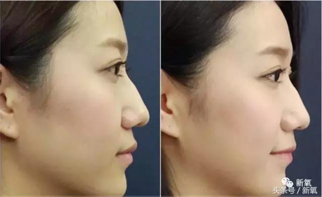 杨紫微整前后容颜对比,杨紫瘦了吗