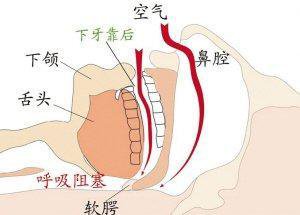 打鼾治疗绝非一朝一夕，这四种简单缓解鼾症的小方法，不妨一试！