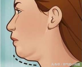 玻尿酸微整形丰下巴多少钱一针,下巴微整形要多少钱