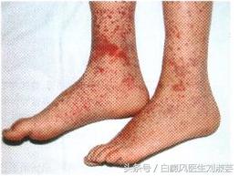 白癜风皮肤病有什么忌口,皮炎湿疹引起的白斑和白癜风区别