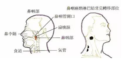 鼻咽癌的早期治愈率可达80以上,鼻咽癌患者最新明细