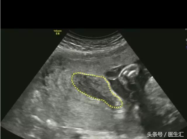 胎盘早剥病例课件,胎盘早剥的超声鉴别诊断