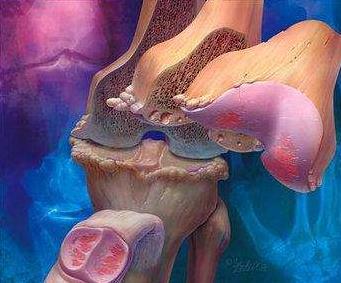 骨关节炎：排在首位的致残性疾病！（附靠谱的三甲医院和医生名单）