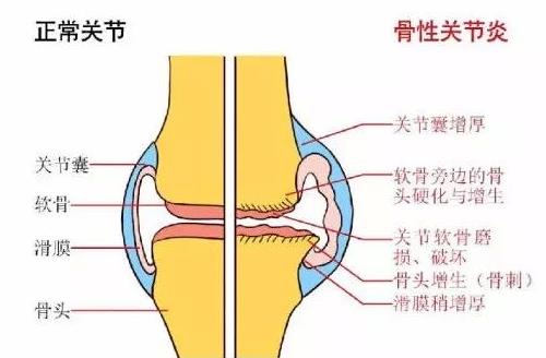骨关节炎：排在首位的致残性疾病！（附靠谱的三甲医院和医生名单）