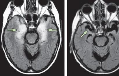 中医治脑炎后遗症最好的方法,脑炎后遗症董氏奇穴治疗