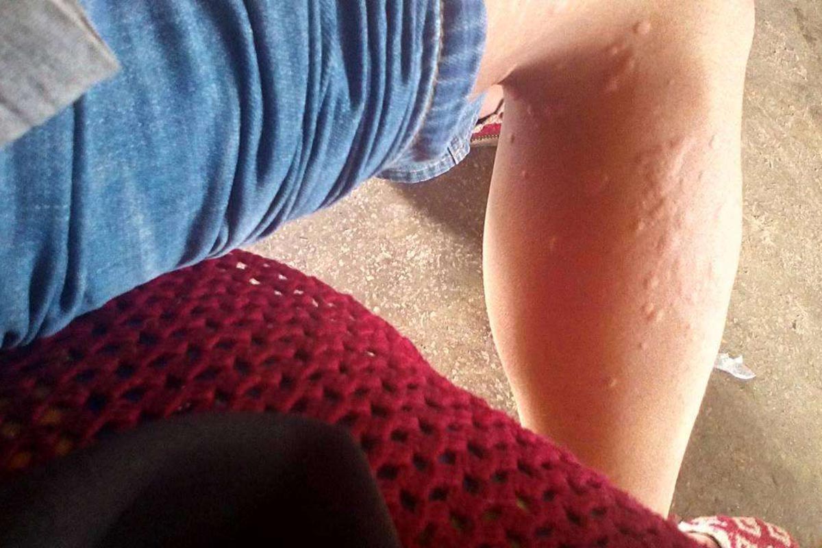 艾灸治疗荨麻疹怎么更严重了,荨麻疹有效的治疗方法艾灸