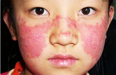 红斑狼疮记忆差怎么改善记忆,红斑狼疮如何消除皮疹