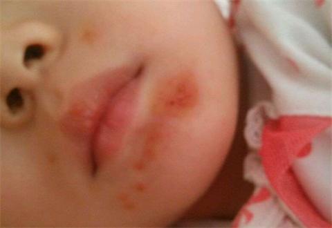 孩子身上长水瘊子怎么治疗,水瘊子最简单的去除方法