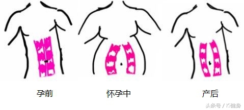 腹直肌及腹直肌分离,产后腹直肌分离