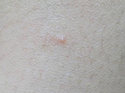 怎么区分扁平疣和皮肤角化症,如何区分脸上的扁平疣和痘痘和斑