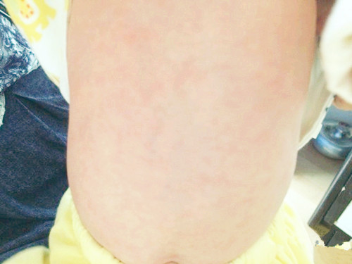 家长说孩子身上有痱子,宝宝身体上有痱子