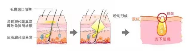 痘痘闭口一直不好,痘痘摸起来硬硬的很疼反反复复