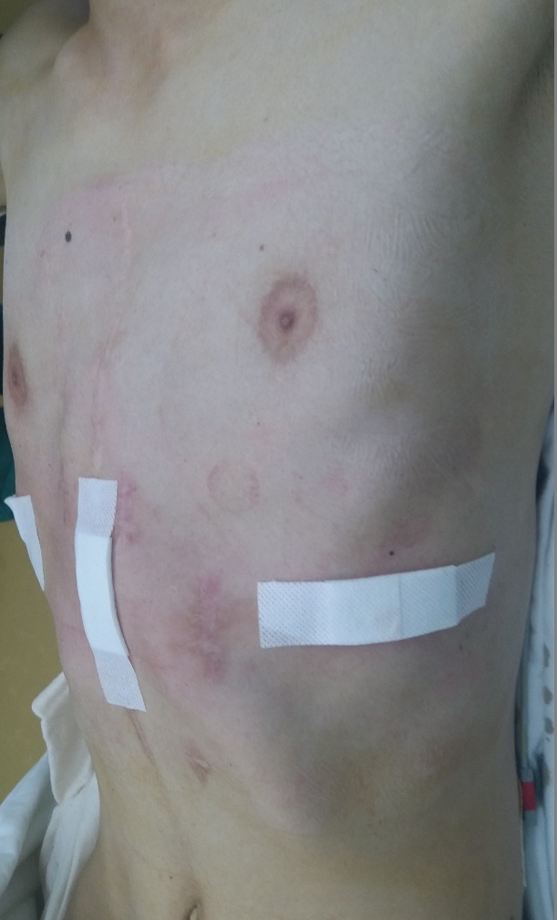 鸡胸手术恢复过程痛苦吗,鸡胸22岁手术还有效果吗