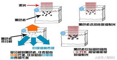 光电祛疤效果图,光电祛斑拯救麻子脸