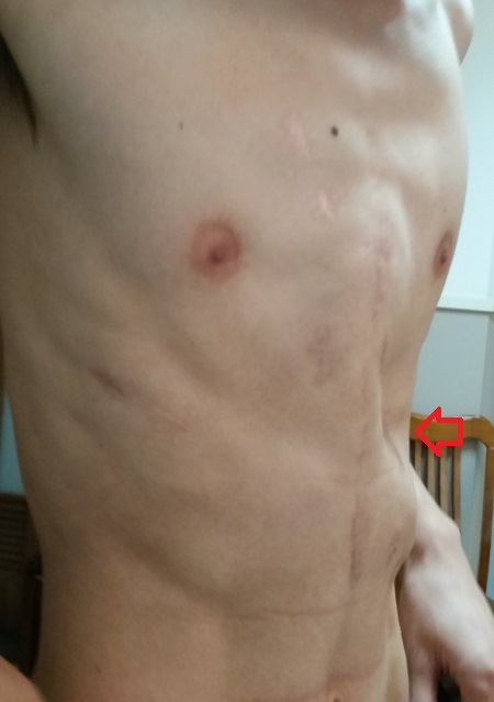 鸡胸手术恢复过程痛苦吗,鸡胸22岁手术还有效果吗