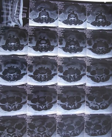 腰椎间盘膨出突出和脱出的区别,腰椎间盘突出膨出脱出哪个更严重
