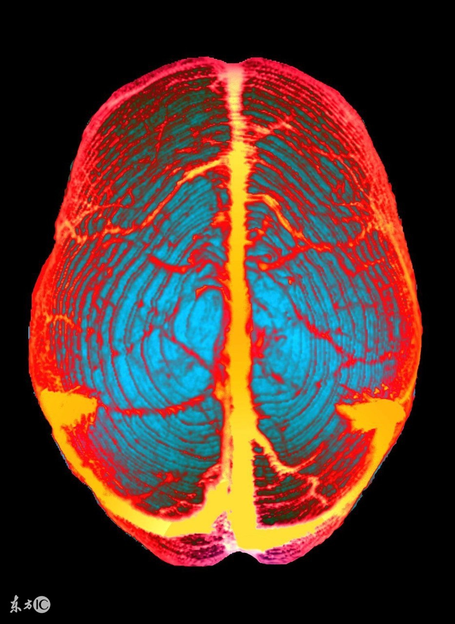 颅内静脉窦血栓形成怎么治疗,颅内静脉窦血栓形成最佳治疗方法