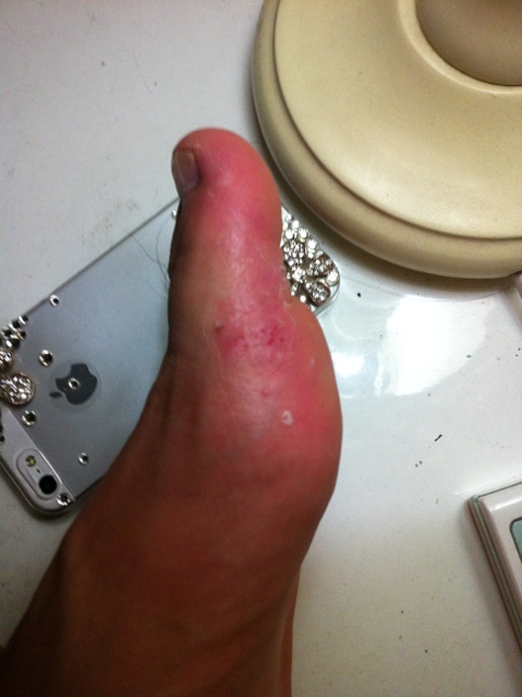 孕妇脚气可以用的脚气偏方,脚气的治疗偏方有哪些方法