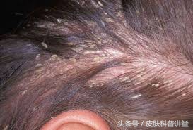 脂溢性皮炎诱因多谁是罪魁祸首,脂溢性皮炎临床指南
