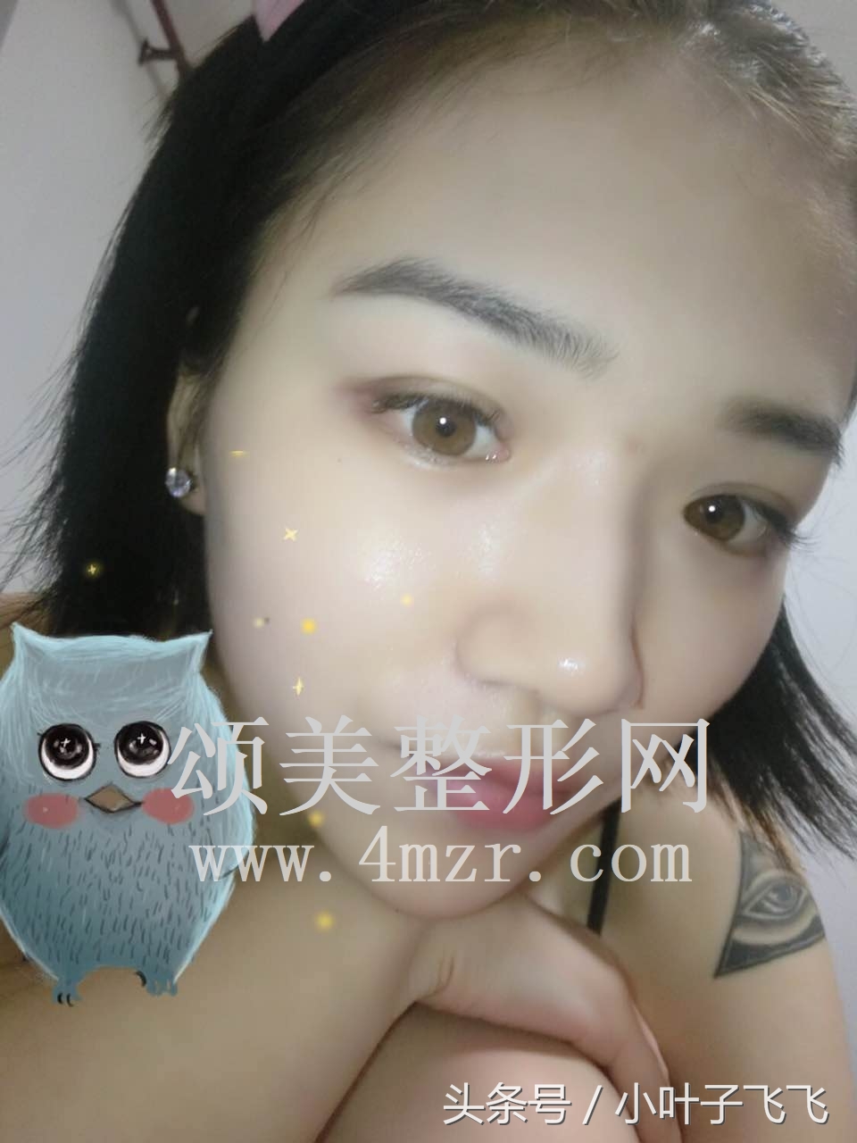 伊婉玻尿酸打面部提升效果怎么样,伊婉玻尿酸中分子打下巴会变形吗