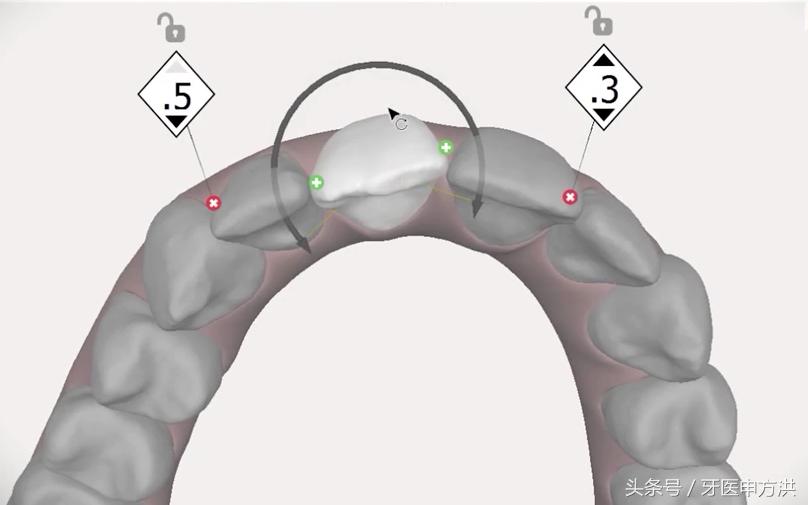 隐形牙套哪个品牌好,隐形牙套到底是什么