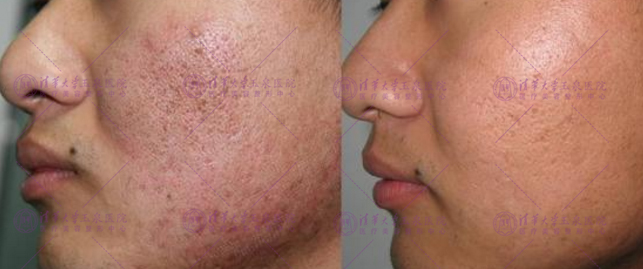 专家推荐祛痘方法,医生推荐祛痘痕痘印最有效的办法