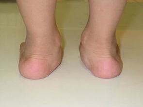 走路脚外翻怎么矫正,脚外翻怎么锻炼最好