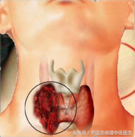 朱迅得甲状腺癌严重吗,祝朱迅早日战胜病魔早日康复